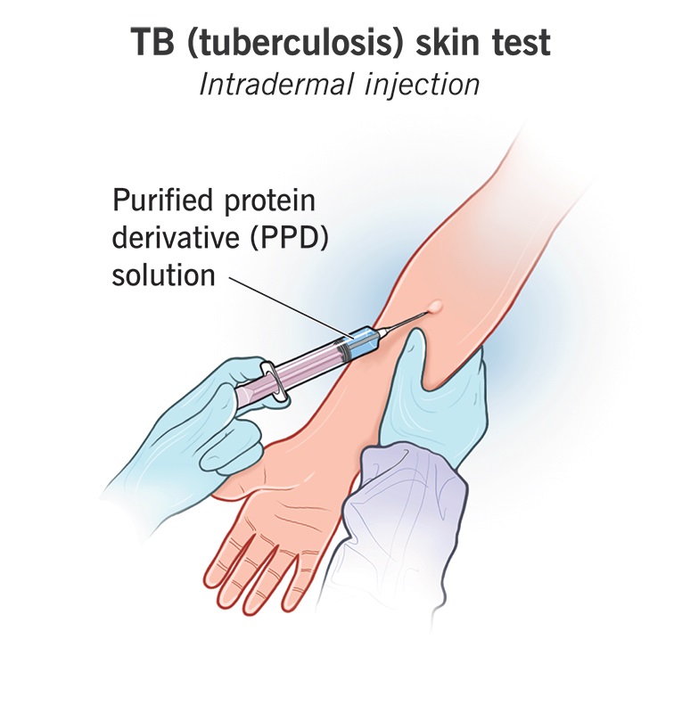 Tuberculosis Latent Skin Testing