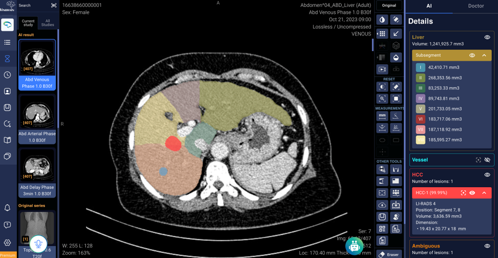 AI early detect liver cancer