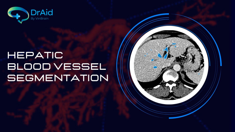 HEPATIC VESSEL SEGMENTATION – Head over to the new feature arrival of DrAid ™!